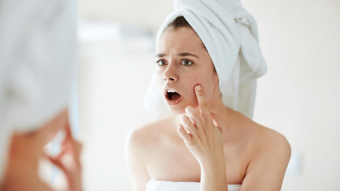 Know what caused that Acne on your Skin