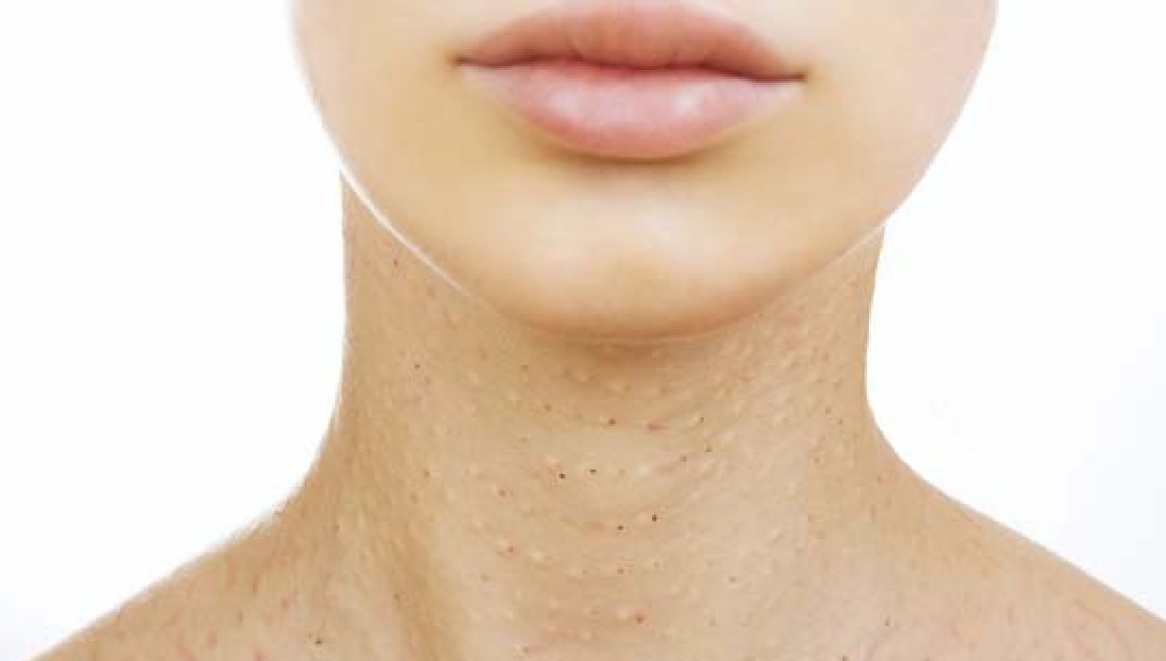 dirty-neck-an-tvak-skin-hair-and-laser-clinic